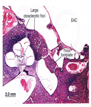 Obliterative Otosclerosis of Oval Window