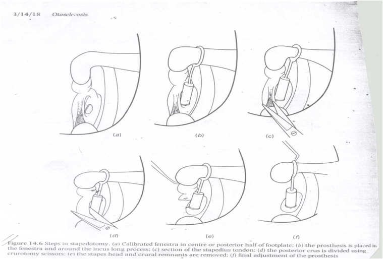 Stapedotomy-Fisch Technique