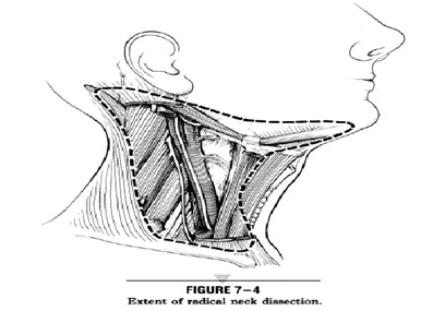 Head and Neck Dissection Radical Neck Dissection