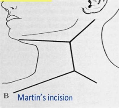 Martins incision/ Double Y incision 