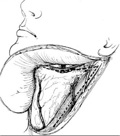 Flap elevation