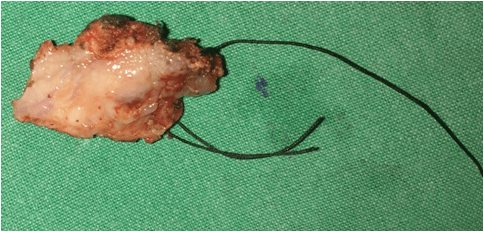 Head and Neck Dissection 21