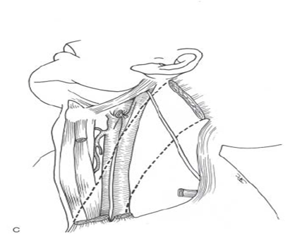 Head and Neck Dissection 25