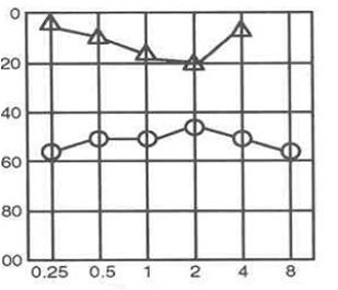 Pure Tone Audiometry