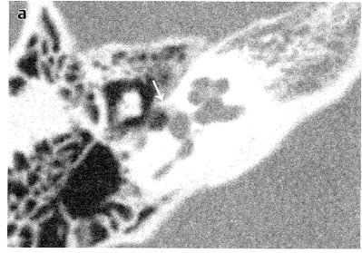 Fenestral Otosclerosis :