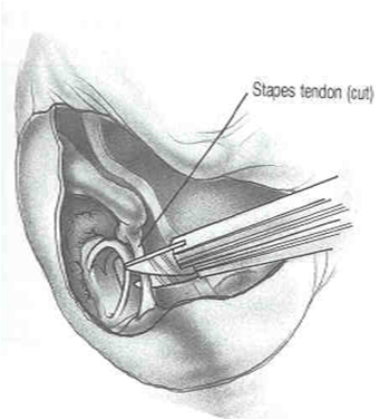 Separation of Incudostapedial Joint