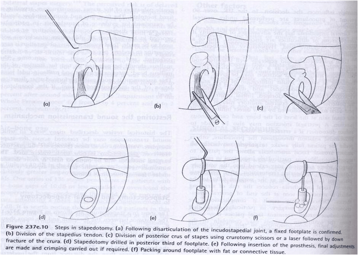 Stapedotomy - Conventional Technique 