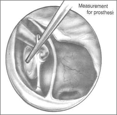 Measurement for Prosthesis